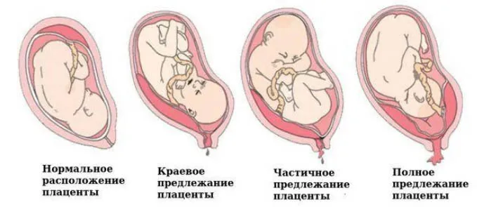 Предлежание плаценты при беременности