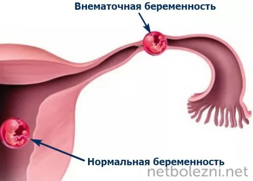 Нормальная и внематочная беременность