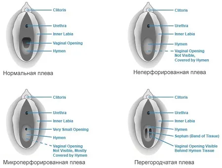 Типы плев у девушек