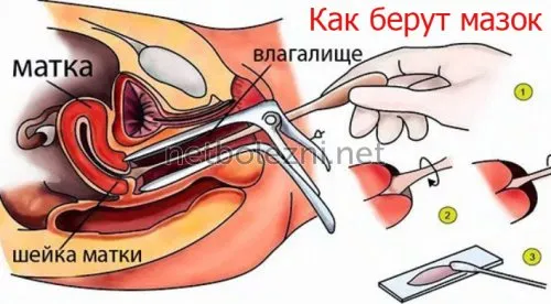 Как берут мазок