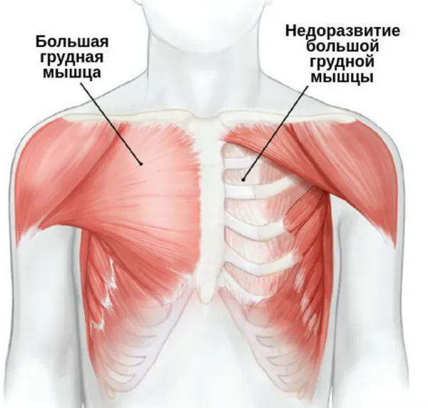 Врождённая гипоплазия молочной железы