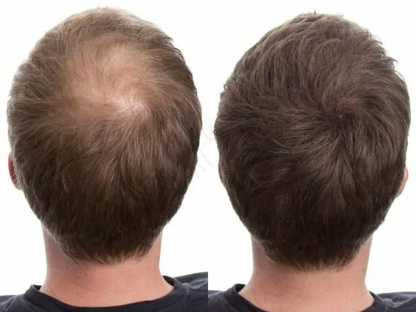 рост волос у мужчин